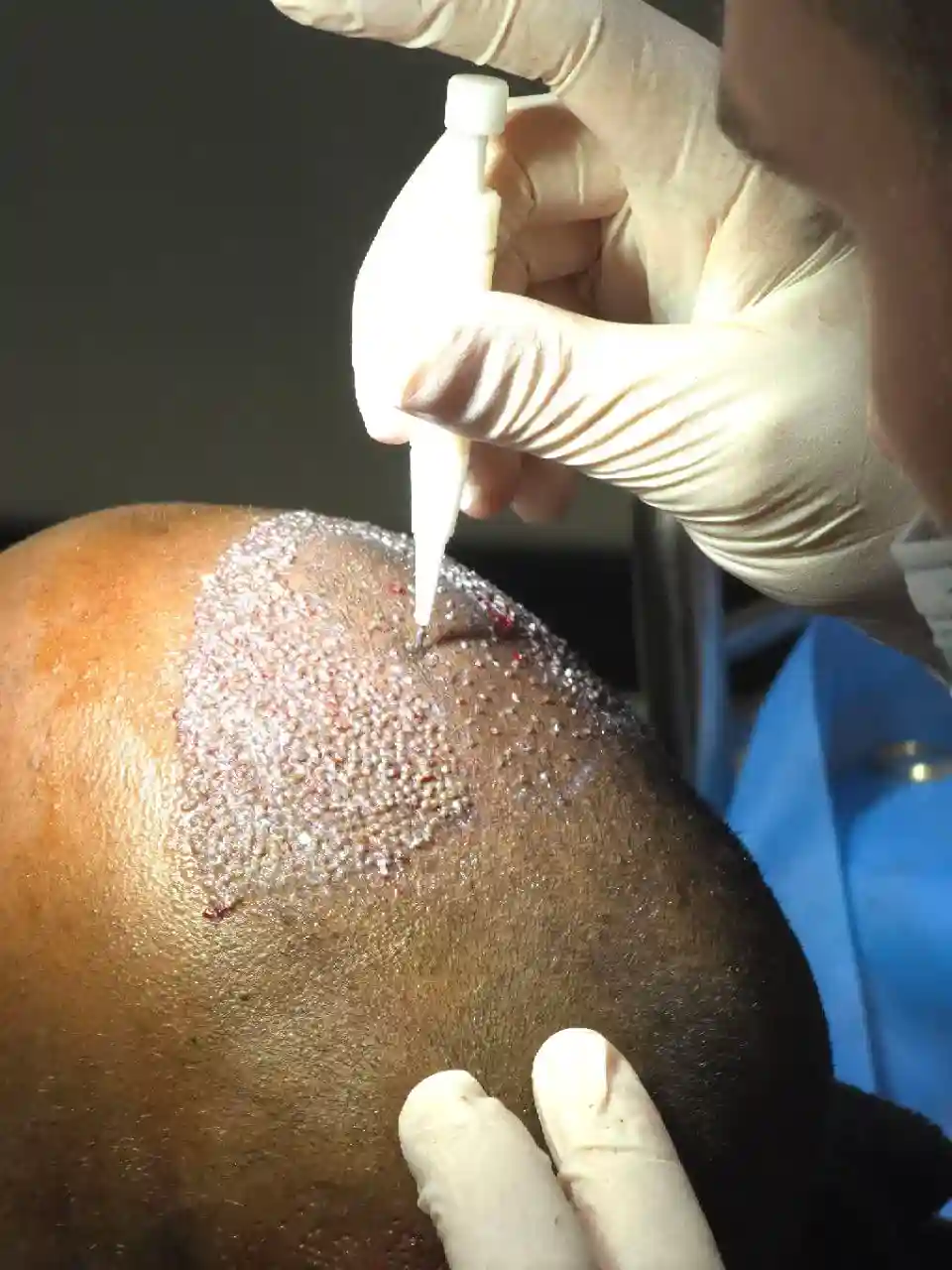 Follicle Implantation