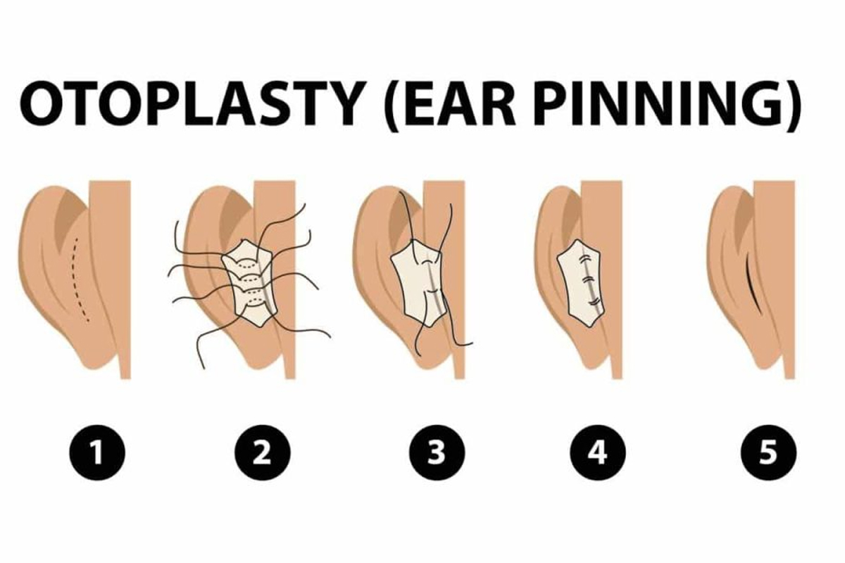 Otoplasty