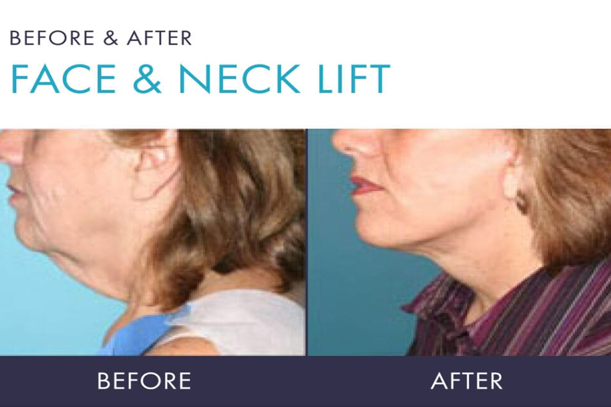 Facelift & Neck Lift